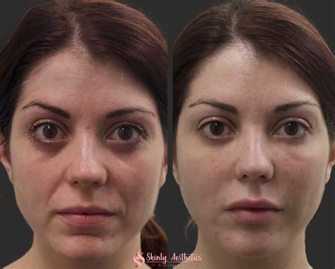 JUVEDERM® Philippines: Lip Fillers, Fines Lines and Dermal Fillers.